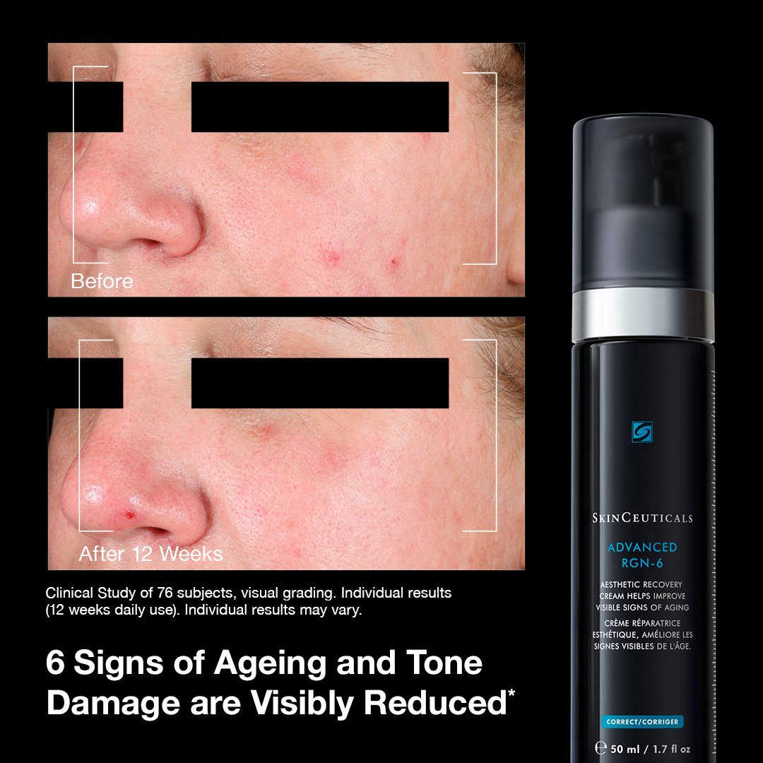 Before and after comparison of skin with age spots and a skinceuticals advanced rgn 6 cream