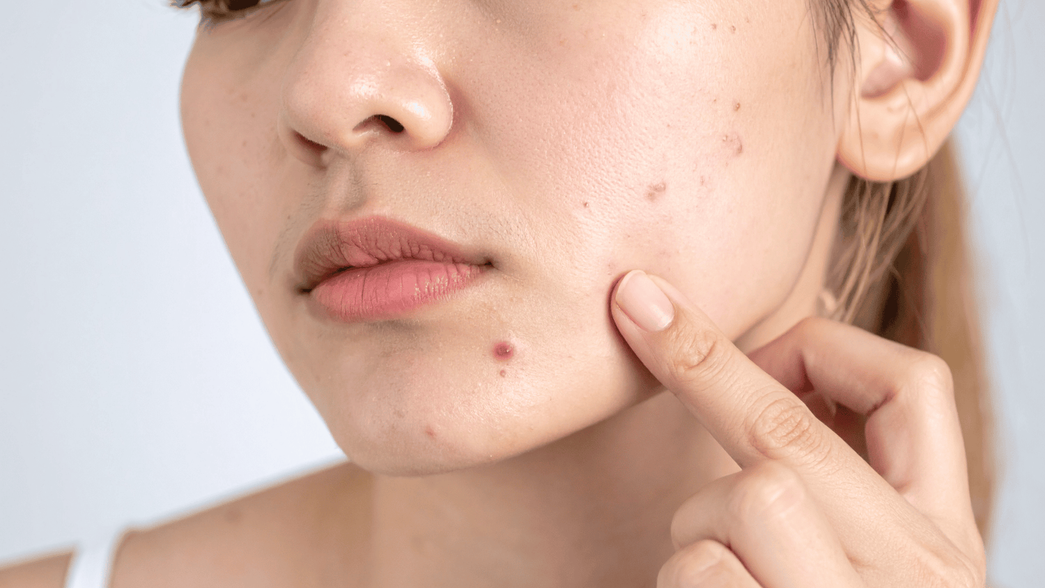Acne-prone skin: building a gentle yet effective routine