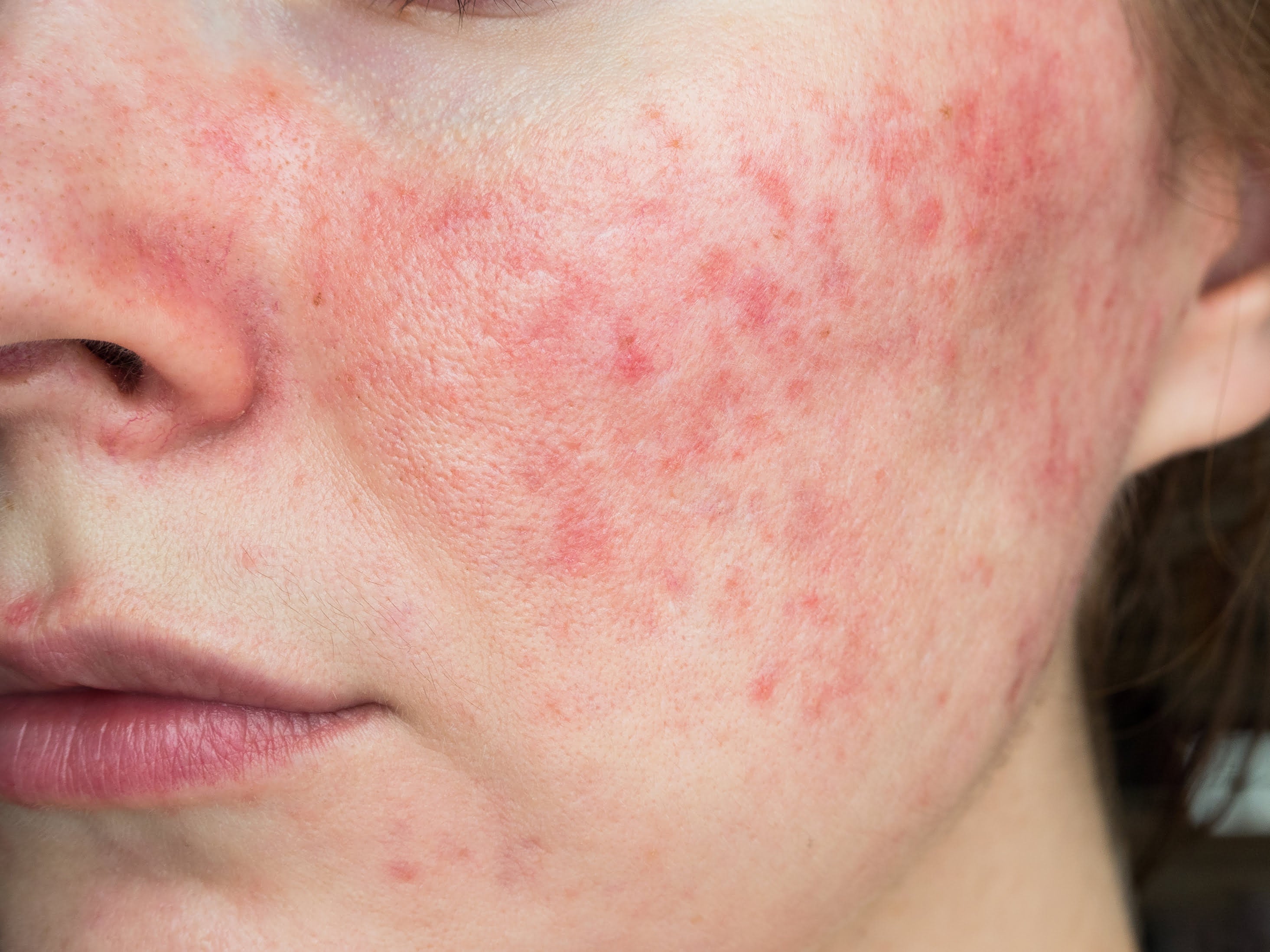 Redness & Rosacea